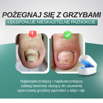 OrthoVital - Laser przeciwgrzybiczny